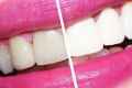 Як відбілити зуби без шкоди?